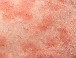Skin rash produced by contact with chemicals
