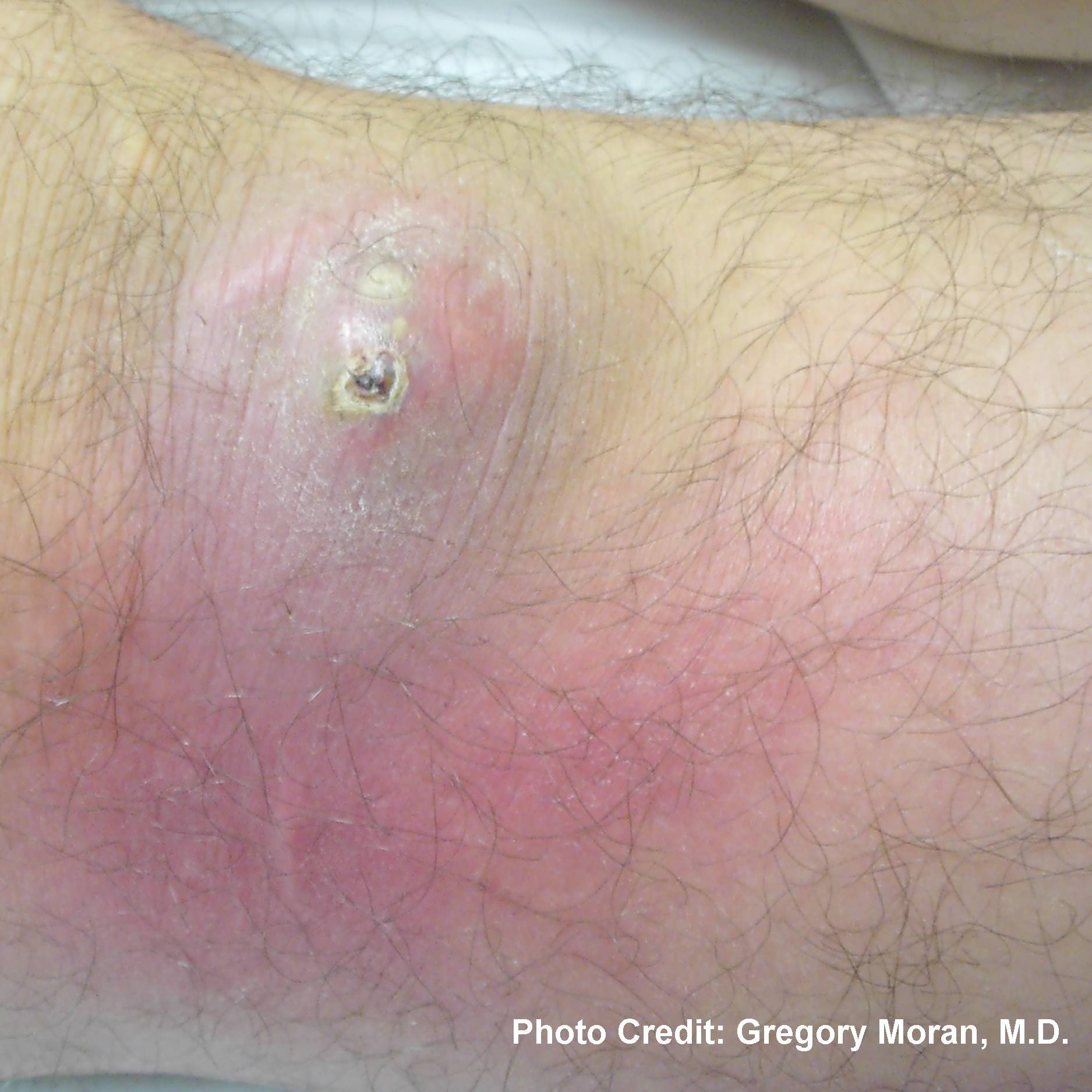 A patient with an infection of MRSA.