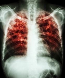 Xray of chest showsing tuberculosis