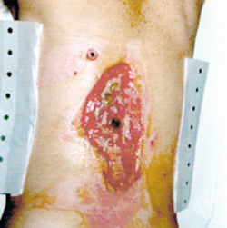 third degree burn on arm from electrical shock