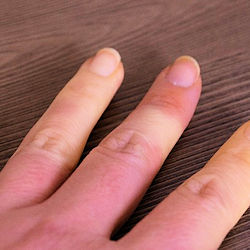 Fingers showing example of white finger syndrome