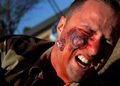 Worker with chemical burns